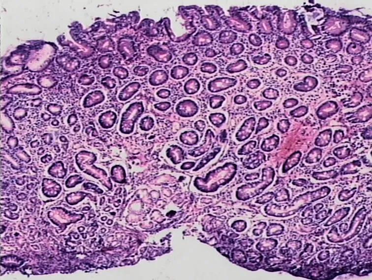 胃息肉一定能癌变吗,胃息肉会癌变吗
