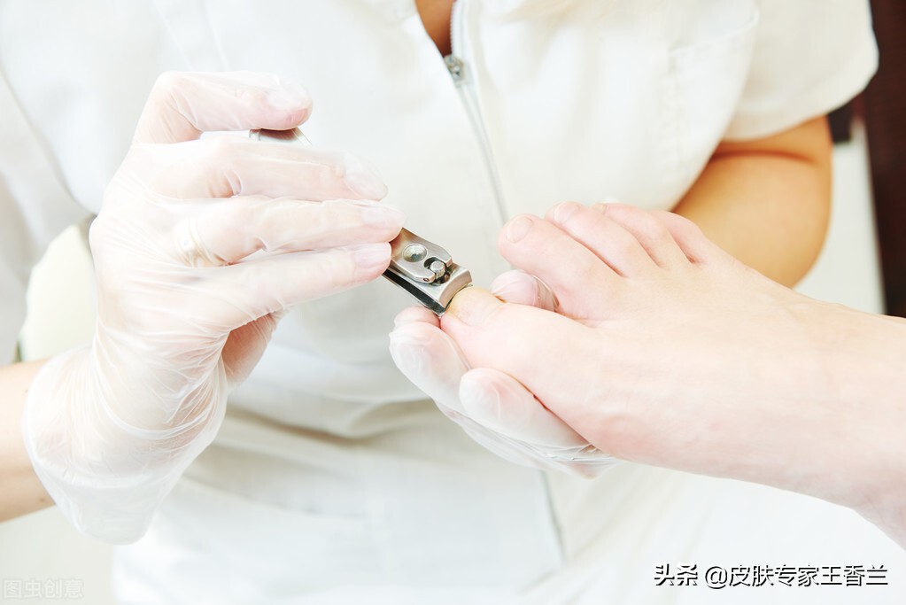 甲沟炎拔脓的药,甲沟炎只用药能好么