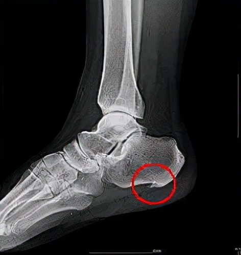 跟骨骨折和足跟骨刺哪个严重,足跟骨刺走路疼痛该如何治疗