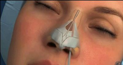 鼻骨太宽应该如何改善？