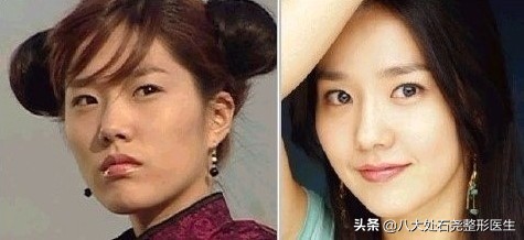 明星太阳穴凹陷怎么解决,太阳穴填充的明星