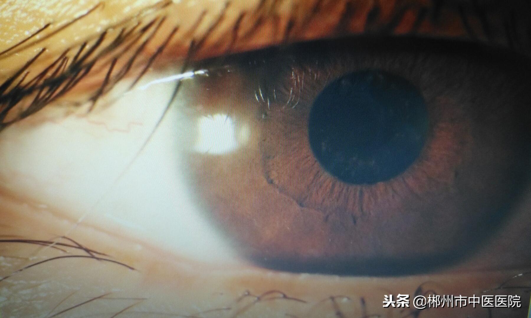 青光眼是不是红眼病,得了红眼病很容易得青光眼吗