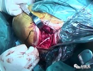 肩锁关节脱位手术后多久可以喝酒,肩锁关节脱位钢板内固定步骤记录