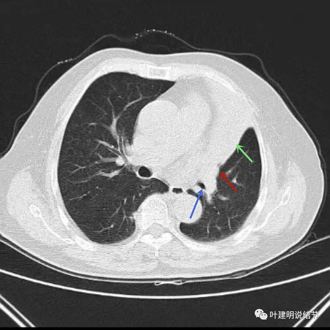 高龄肺癌靶向治疗效果,高龄老人肺癌早期适合放疗吗