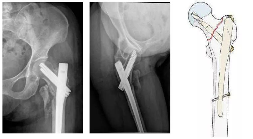 老年髋部骨折最常见的部位,髋部骨折危害大老年人摔伤要重视