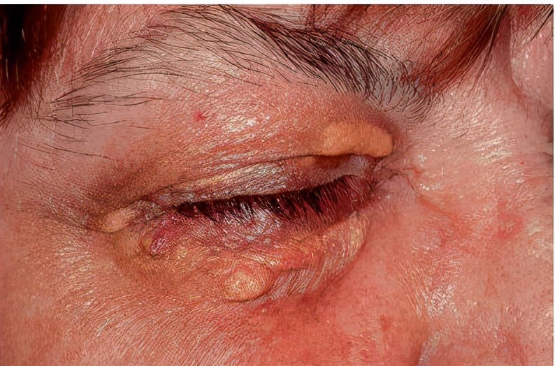 脸上长了闭口小颗粒怎么去除,脸上白色颗粒怎么去除