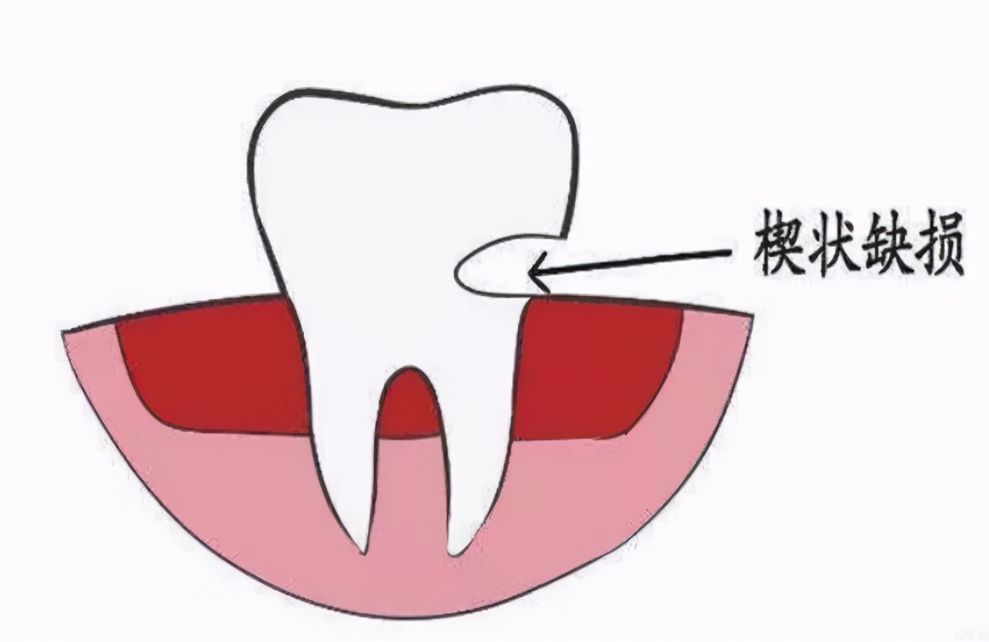 为什么乳牙好换牙就不好了,为什么现在的孩子换的门牙特别大