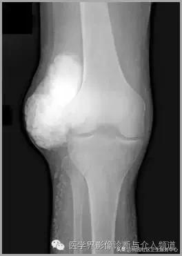 软组织钙化是不是骨化性肌炎,软组织钙化或骨化