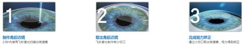 征兵近视手术最佳方案,征兵眼睛近视激光手术流程