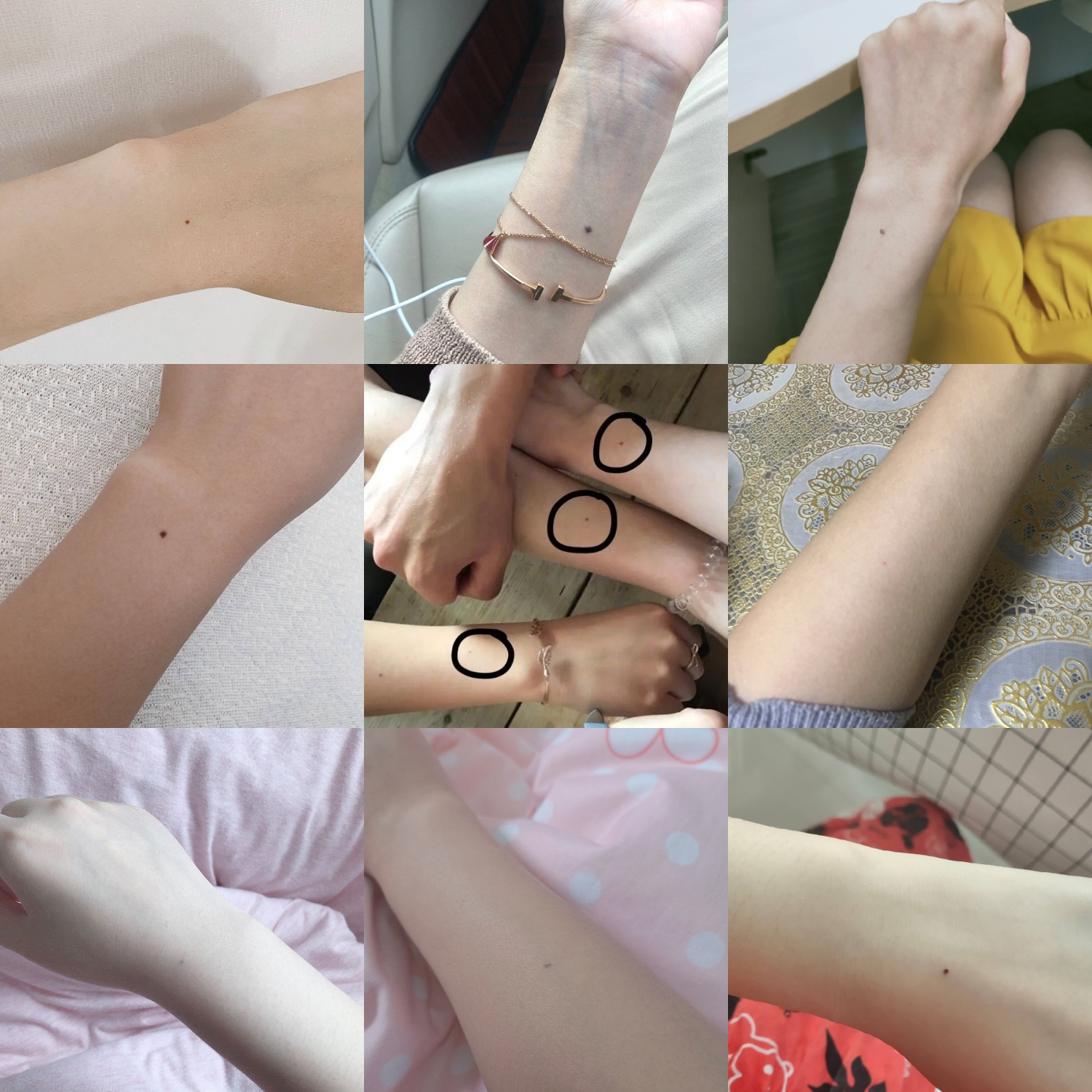 手臂胎记里面有13颗痣代表什么,胳膊胎记上长痣说明什么