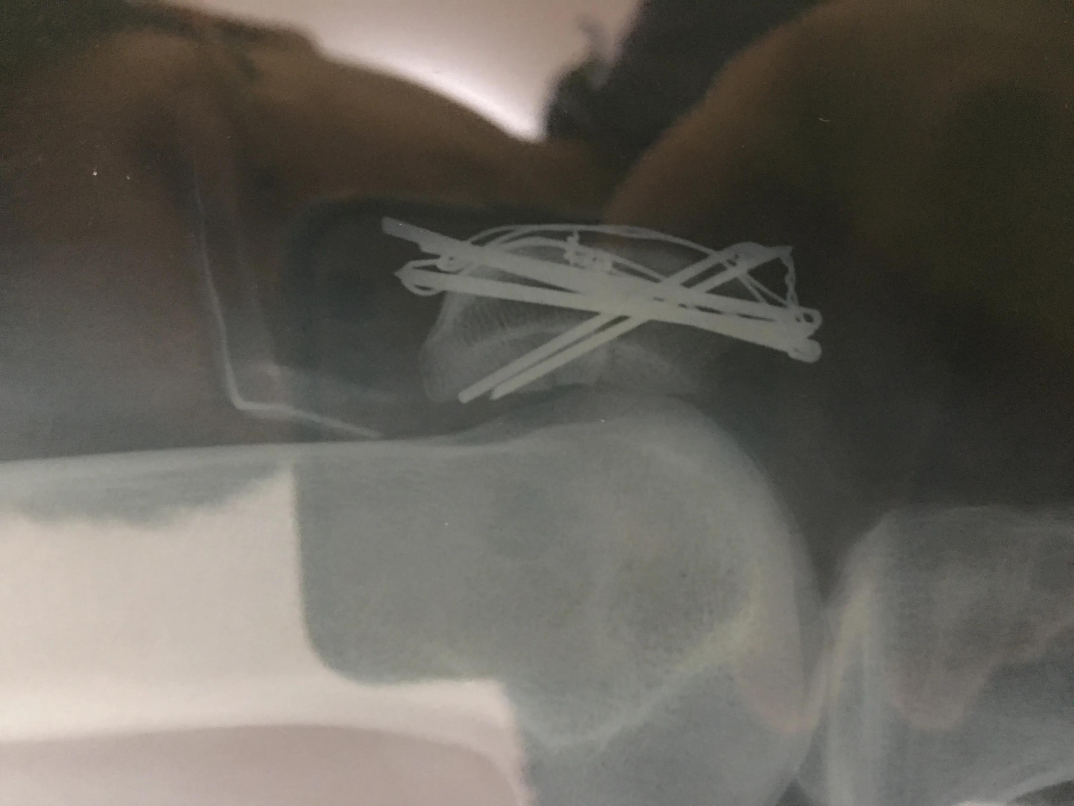 髌骨骨折取内固定费用多少,髌骨骨折保守治疗后的康复训练