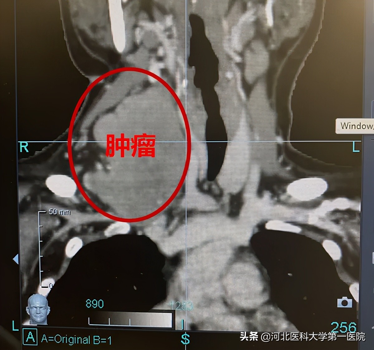 神奇魔法刀,一点就消!点亮肿瘤绝境患者,再生的希望之光