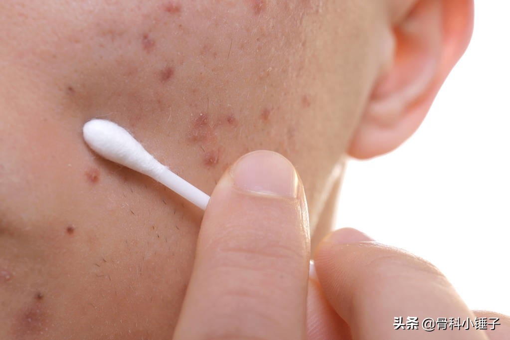 激素皮炎与脂溢性皮炎区别,脂溢性皮炎和激素依赖症