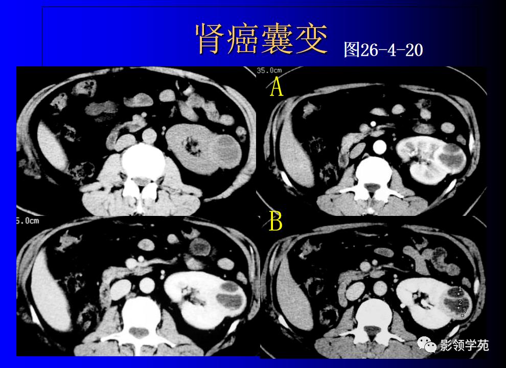 肾脏囊性肿块的影像学特点,肾脏典型病理图片及解析