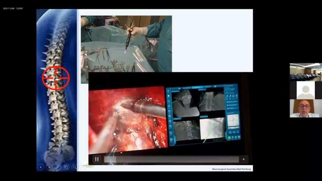 中德万里连线，讨论脊柱疑难病例