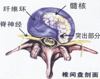 腰椎突出和膨出脱出图片,腰椎间盘突出脱出膨出的区别