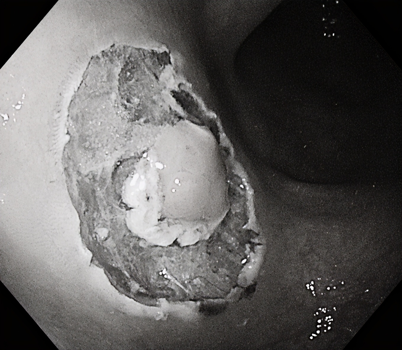 良性肿瘤也可用内镜下黏膜剥离术,内镜下粘膜剥离术后残留肿瘤