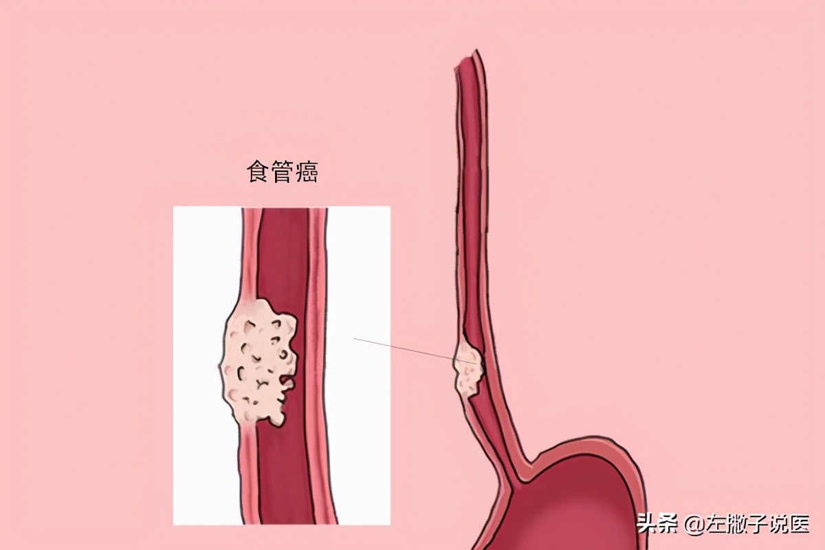 澶氬枬鐑按鍙兘鏄嚧鐧岀殑鍥犵礌,65搴︾殑鐑按涓轰粈涔堜細鑷寸檶