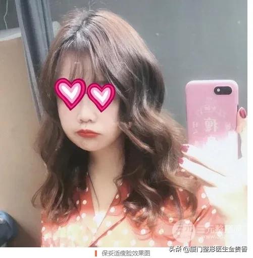 保妥适是玻尿酸还是肉毒素,保妥适效果不明显