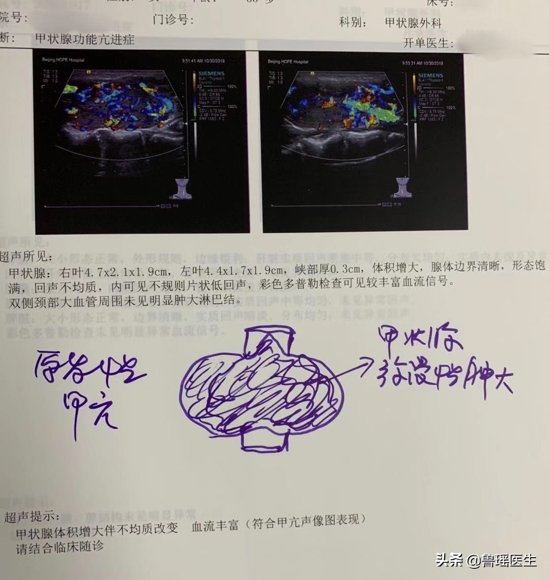 舞蹈老师患上甲亢，吃药有副作用手术又担心留疤痕，该怎么办？