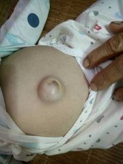 宝宝脐疝会不会有什么不适感,宝宝出现脐疝怎么处理