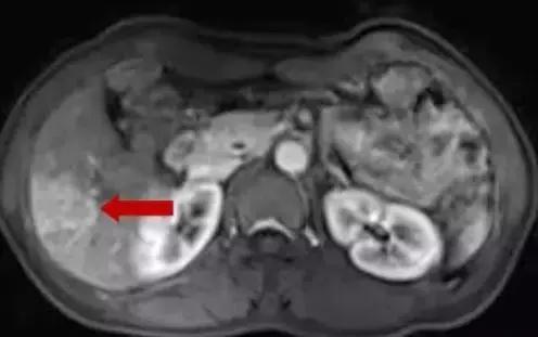 直肠癌病例分享,直肠癌肝转移做射频消融动画演示