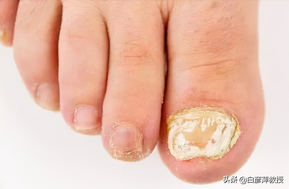 灰指甲是灰色的吗？灰指甲真的会传染吗？皮肤科医生告诉你