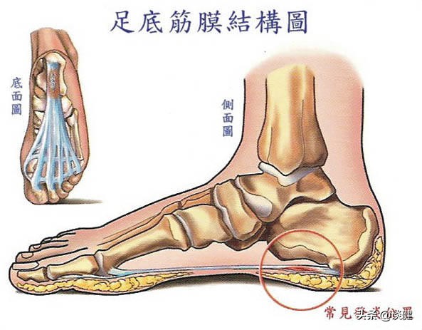 足底筋膜炎针刀疗法管用吗,足底筋膜炎可以用小针刀疗法吗