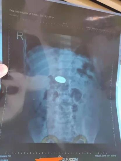 儿童误吞异物的正确方法,孩子不小心吞入异物卡住了怎么办