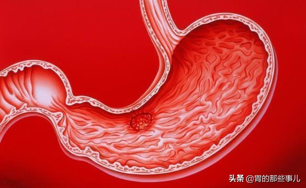 我肠胃炎犯了怎么办,肠胃炎反复发作会致癌