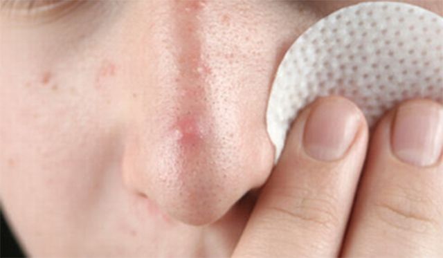 痘肌精华推荐祛痘印学生,油痘肌好用的祛痘精华推荐