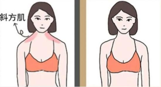 瘦肩针多少钱一针能保持多久,瘦肩针注射视频教程