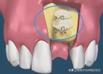 缺牙太久邻牙倾斜可以磨掉吗,缺牙太久导致旁边的牙倾斜了