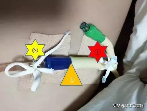 尿管固定别小看5cm，却是“血”的差距！