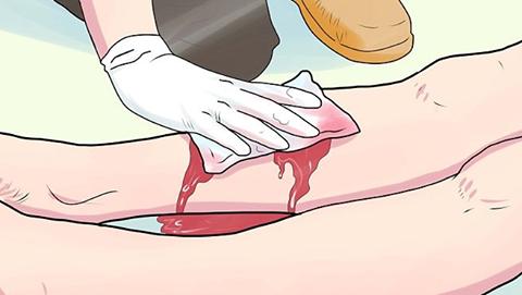 肝硬化胃底静脉曲张重度大出血,肝硬化静脉曲张大出血能活多久