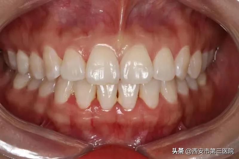 常见牙齿美白方式大盘点,牙齿美白性价比最高的方法