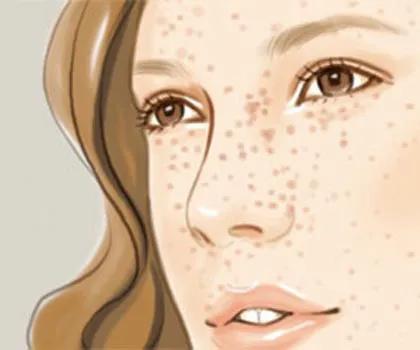 如何区别脸上斑是雀斑还是黄褐斑,雀斑和褐斑有什么区别吗