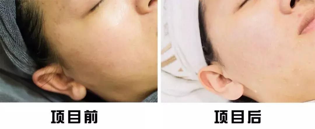 9.9元开启杭州女孩的高光时刻！变白变嫩变漂亮