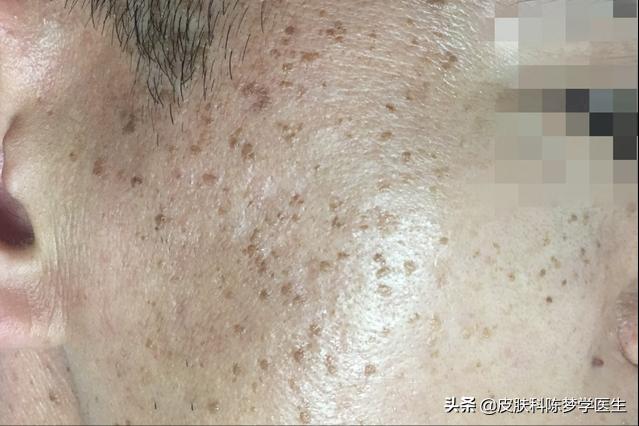 脖子上小肉球和丝状疣的区别,脖子上长了个细长的小肉球严重吗