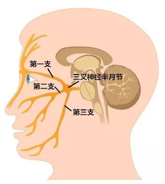 射频热凝治三叉神经痛的过程,射频治三叉神经痛治疗过程