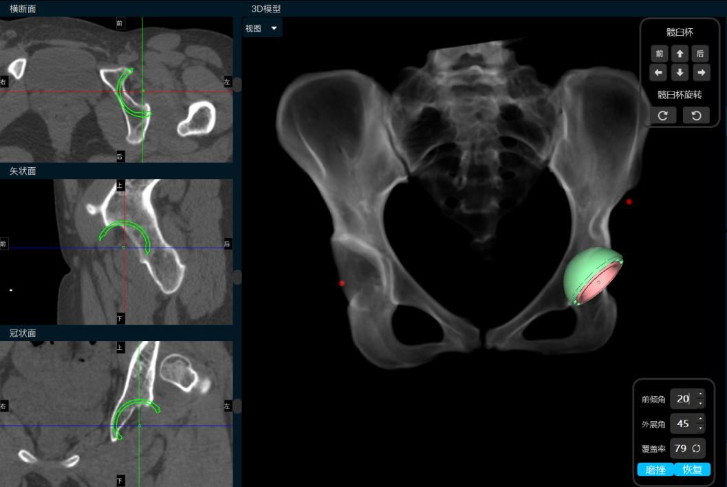 AI助力精准处理IV型髋关节发育不良花季少女翻开人生新篇章