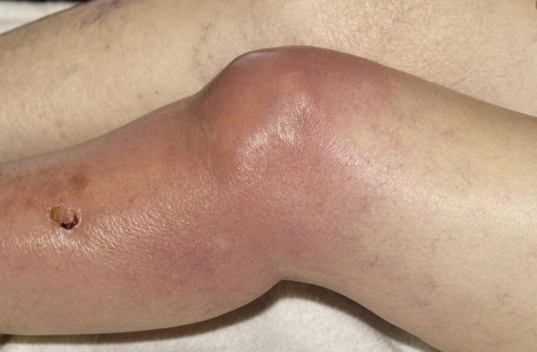 膝关节滑膜炎积液可以痊愈吗,滑膜炎膝盖积水能自愈吗