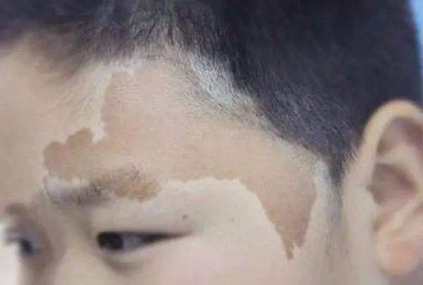 皮秒太田痣激光恢复过程,治疗太田痣费用贵吗