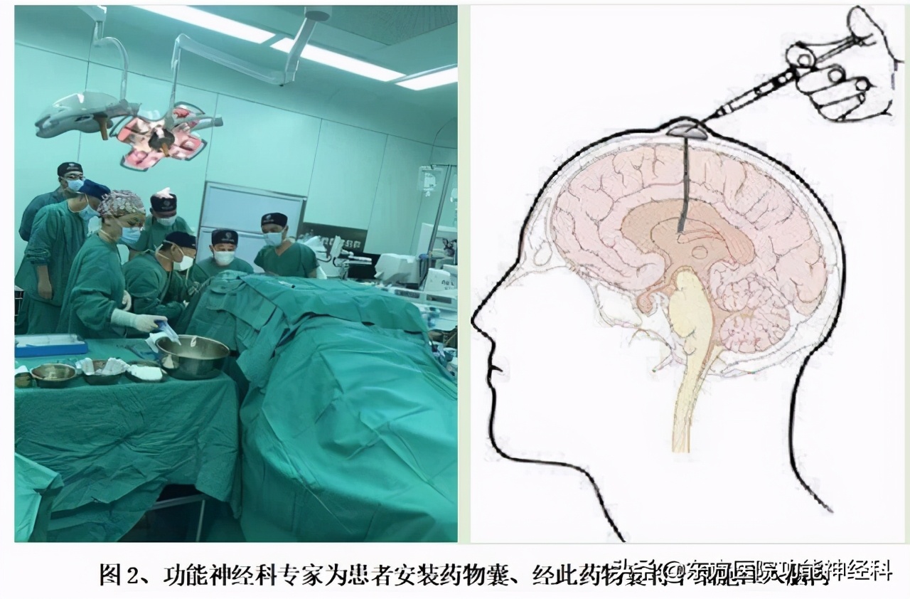 干细胞移植治疗脑中风后遗症进展,干细胞治疗缺血性卒中