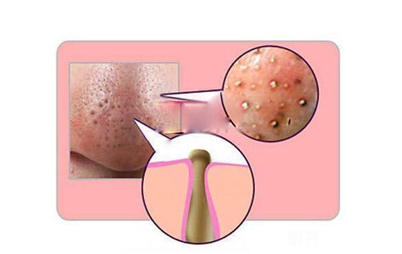 为什么挤黑头伤毛孔,为什么挤黑头时间长了心慌