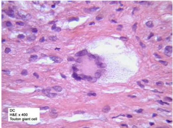 一岁孩子眼皮有几个疹子,小孩上眼皮长的像癣一样的东西
