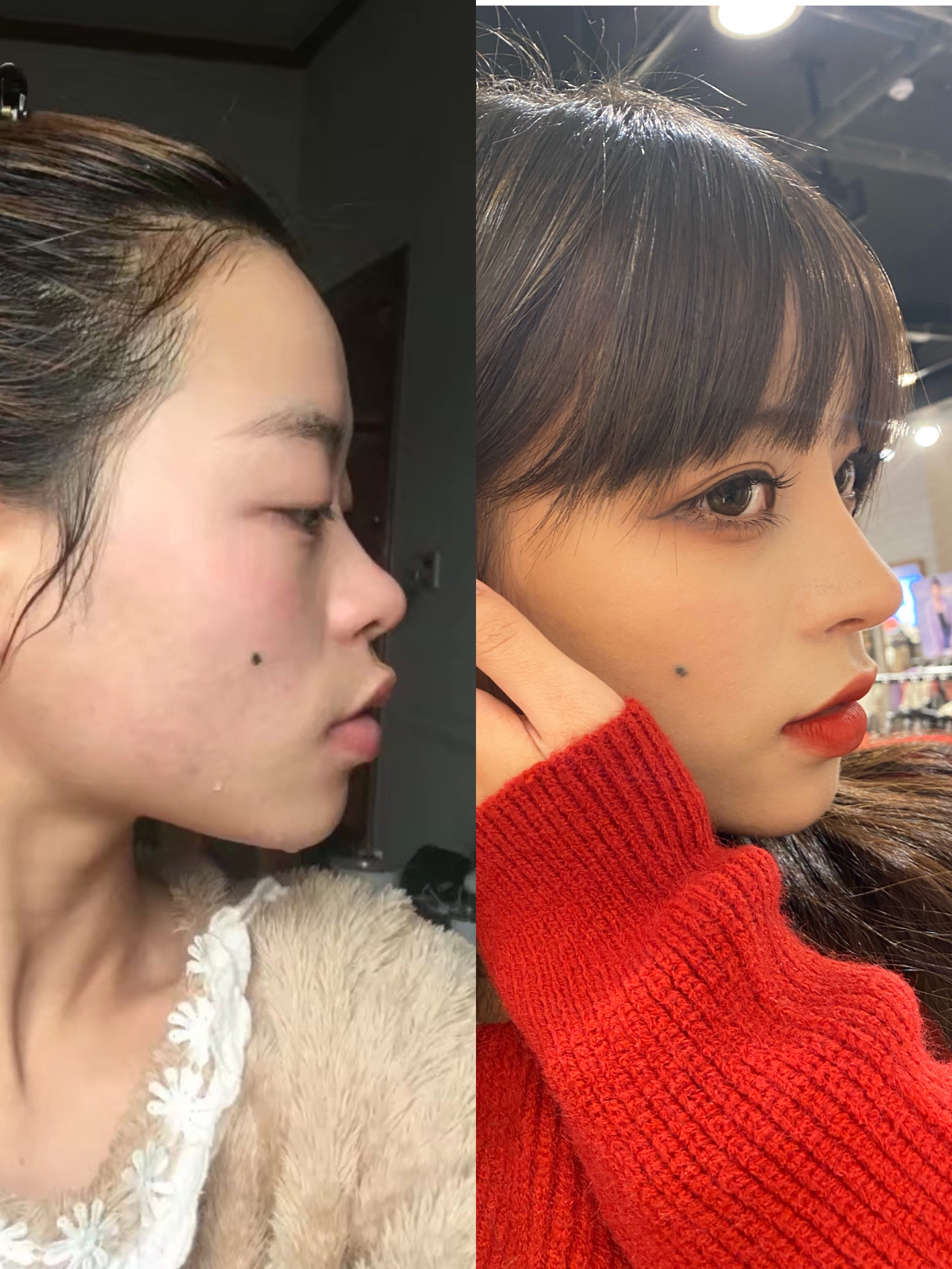 2022年流行鼻整形的全过程视频,大宽鼻手术案例