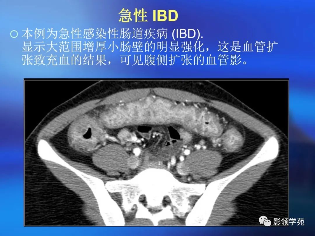 肠道内壁增厚,肠道扩张ct表现