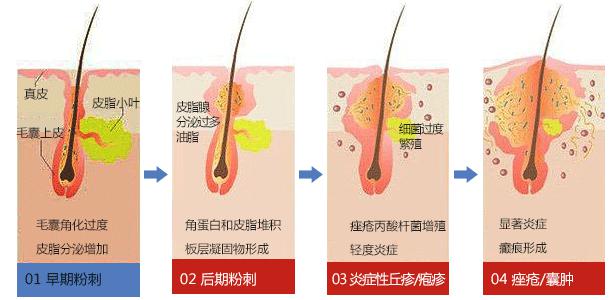 崔雪莉抑郁自杀,英国伯奢BOXURY发现痘痘竟然也能引发抑郁