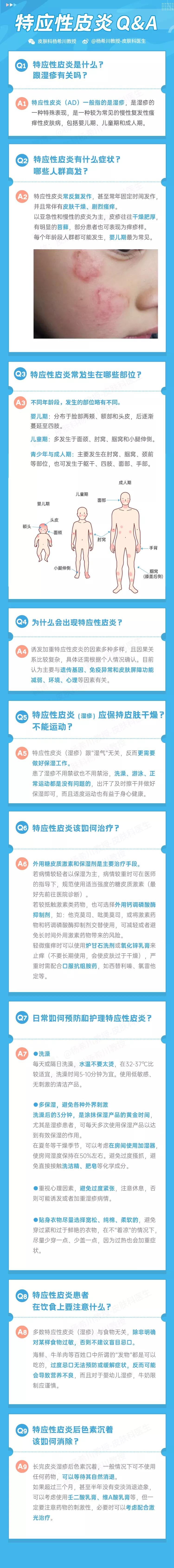 想要治疗湿疹是不是得先治胃,烦人的湿疹怎么治